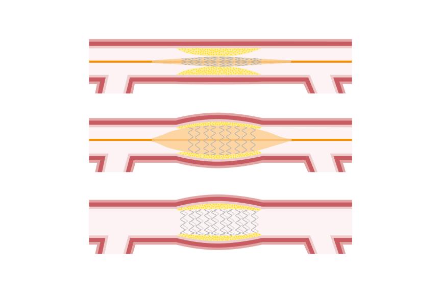 Graphic of what is required for a Scaffold to provide a vascular restoration therapy